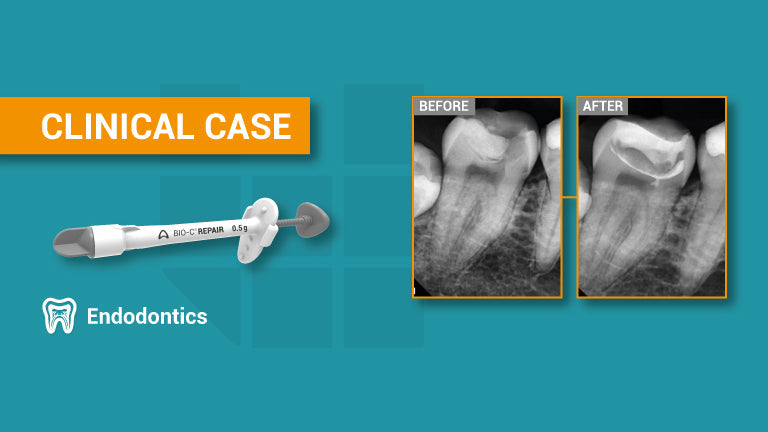 Direct and indirect pulp capping using Bio-C Repair bioceramic cement