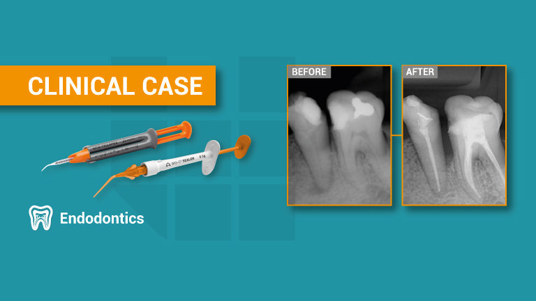 Use of MTA-FILLAPEX and BIO-C SEALER endodontic sealers in pulp necrosis