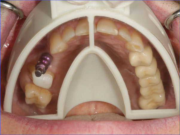 Miratray Implant