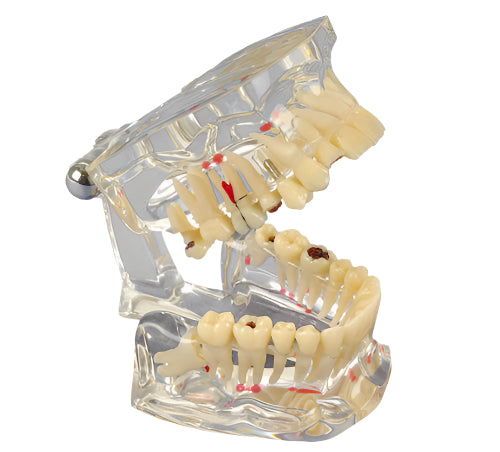 Study Implant Model